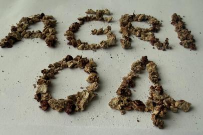 Ağrı'da gerçekleştirilen ameliyatta 295 taş başarıyla çıkarıldı