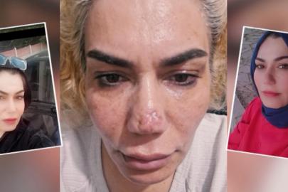 Estetik ameliyatında burnu bu hale geldi, doktordan şikayetçi oldu